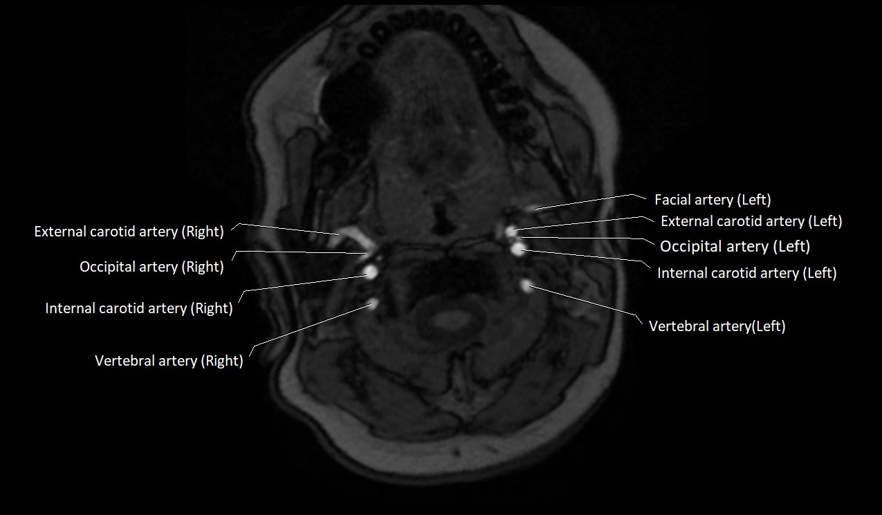 Carotid artery anatomy axial 3T image 17.jpg
